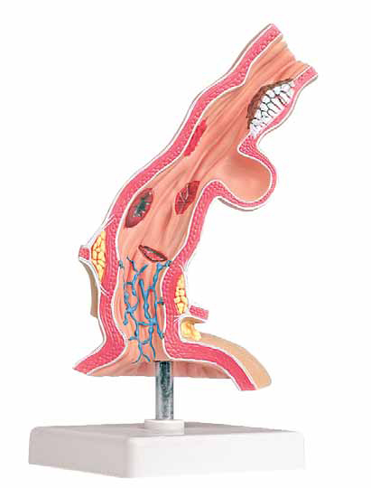 Pathological Model of Esophagus